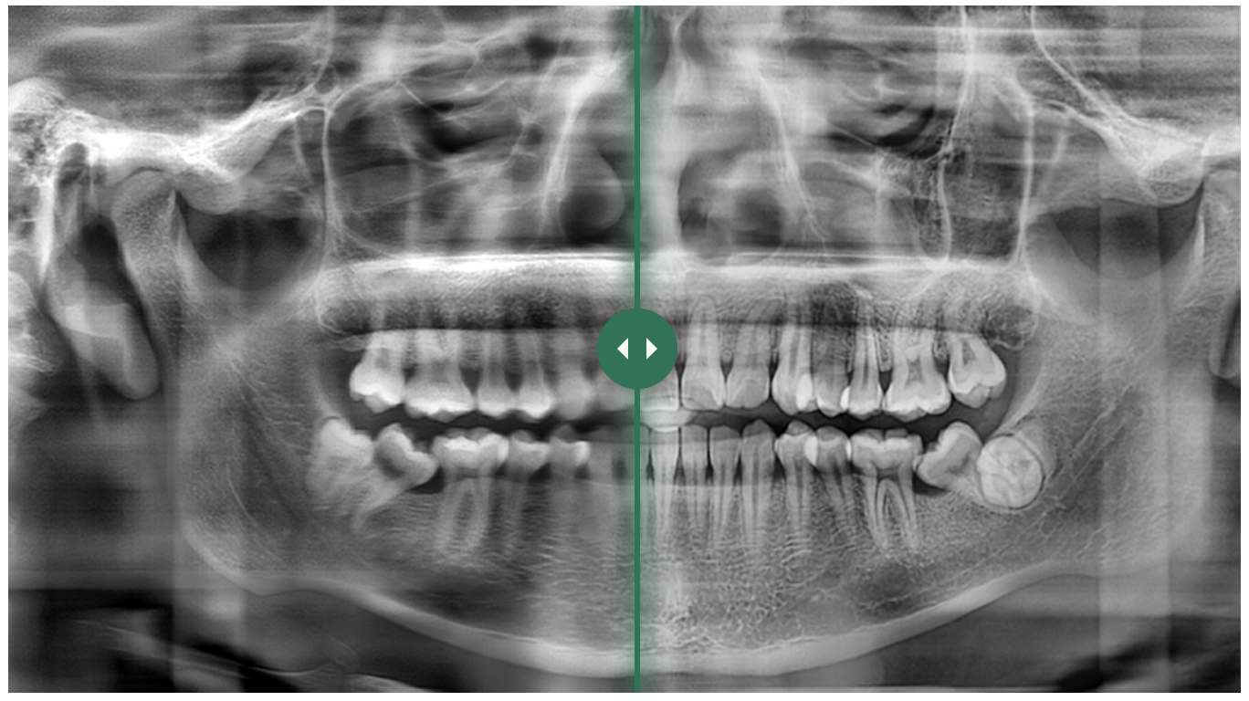 Intelligence artificielle panoramic dental meyer france cbct