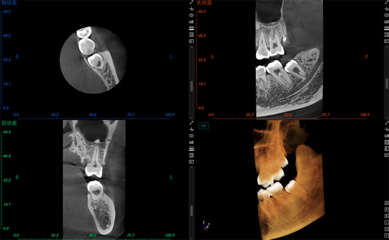 PARTIAL CT MEYER DENTAL